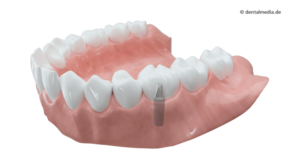 krone implantat getragen krone vollkeramik