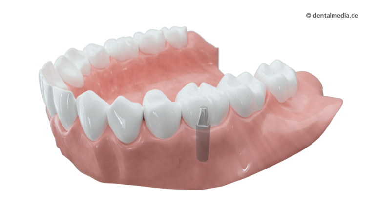 krone implantat getragen krone vollkeramik