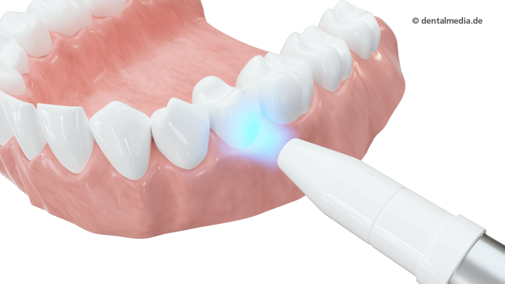 laser bleaching