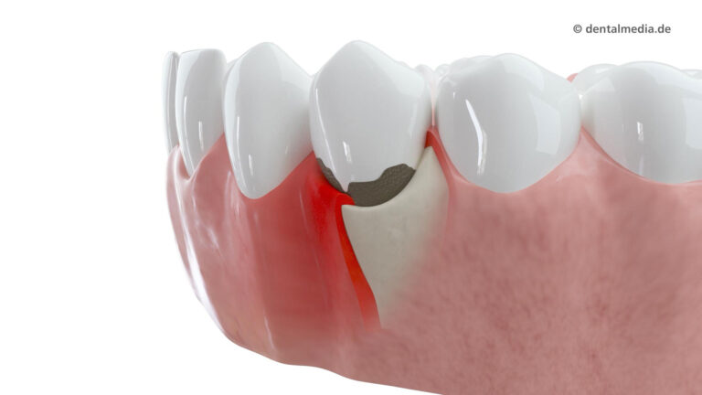 Paradontitis — Mehr als Zahnfleischbluten