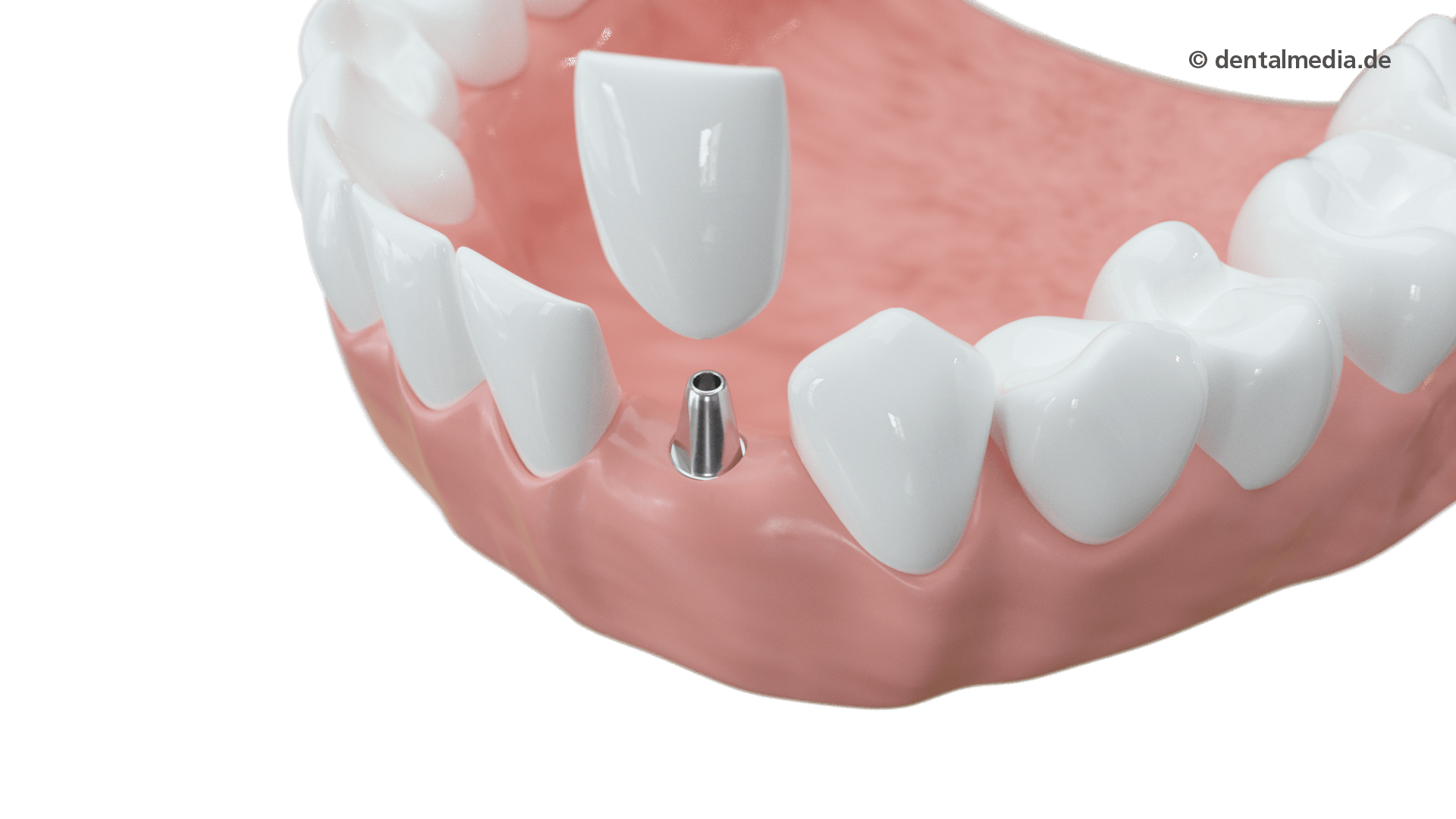 schaltlücke mit implantat und zahn